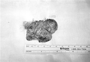 Hiếm gặp: Bệnh nhi 10 tuổi nhập viện với khối u tuyến giáp lớn