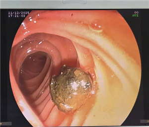 Nội soi mật tụy ngược dòng – Giải pháp tối ưu cho người bệnh sỏi ống mật chủ