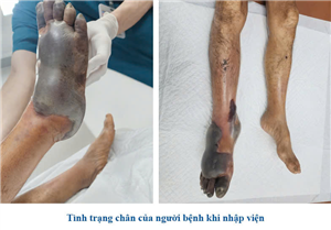 Chủ quan với vết xước nhỏ, người đàn ông 54 tuổi nhập viện trong tình trạng nhiễm trùng huyết nặng