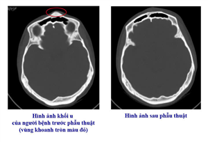 Từ triệu chứng mơ hồ đến phát hiện u xương sọ hiếm gặp