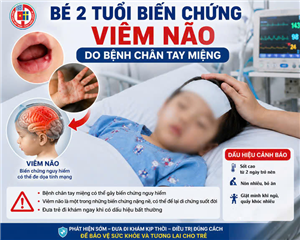 Bé 2 tuổi biến chứng viêm não do bệnh chân tay miệng
