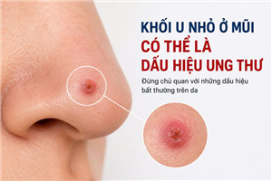Phát hiện ung thư từ khối u nhỏ vùng mũi tưởng chừng vô hại