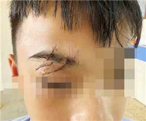 Cảnh báo tai nạn thương tích trẻ em dịp nghỉ hè